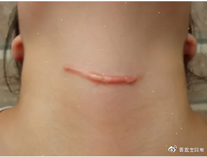 已经形成的疤痕增生怎么去掉,疤痕为什么越长越大