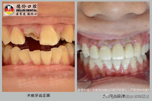 里面的牙如何修复,现在哪里有修复牙齿的