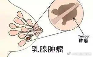 乳腺增生不治会好吗,男人有乳腺增生会有什么后果