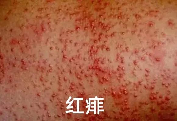 爽身粉去热痱子,长痱子用爽身粉可以去痱子吗