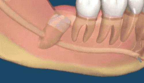 拔智齿是怎么算收费的,拔智齿是按智齿个数收费吗