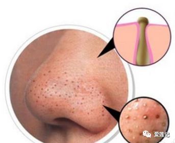 有这6个症状说明你的经络堵塞了,身体有5个征兆说明血管堵住了