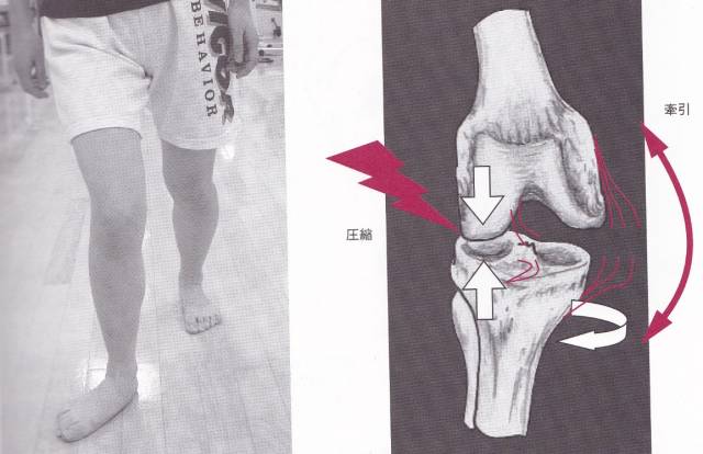 外八字脚会不会影响膝盖,跑步时八字脚产生原因及纠正方法