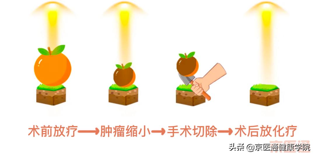 放射治疗别担心肿瘤杀手来帮您,肿瘤的放射治疗辐射