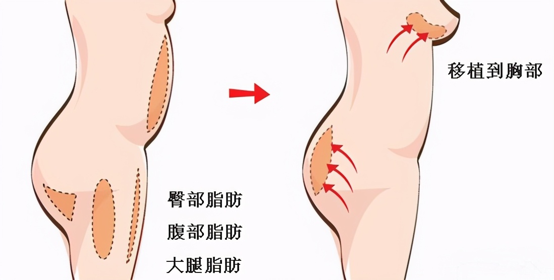 男士自体脂肪隆胸成c杯,自体脂肪隆胸会长结节吗