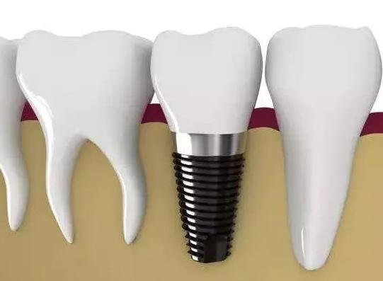 种植牙安装了牙冠后当天注意事项,种植牙埋钉后饮食注意事项