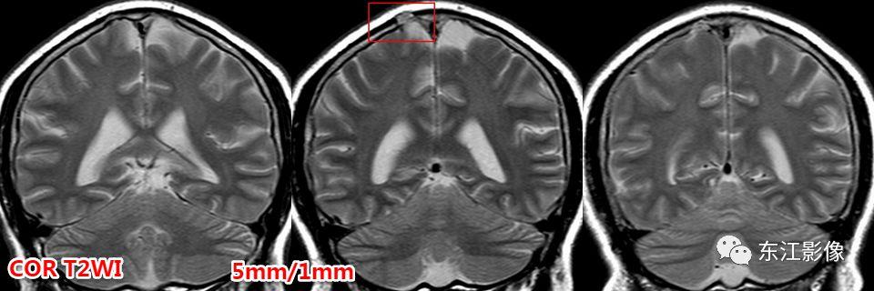 头颅mri扫描影像哪里找,头颅影像mra详细解说