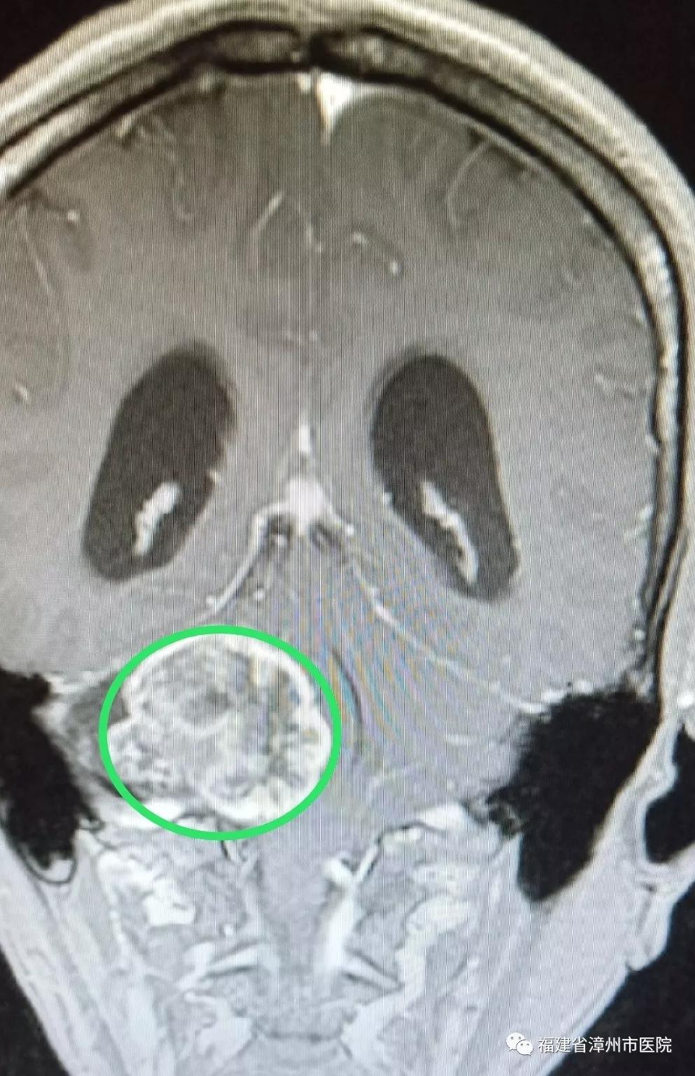 听力下降是耳朵出问题吗,着急一侧耳朵耳鸣听力减退