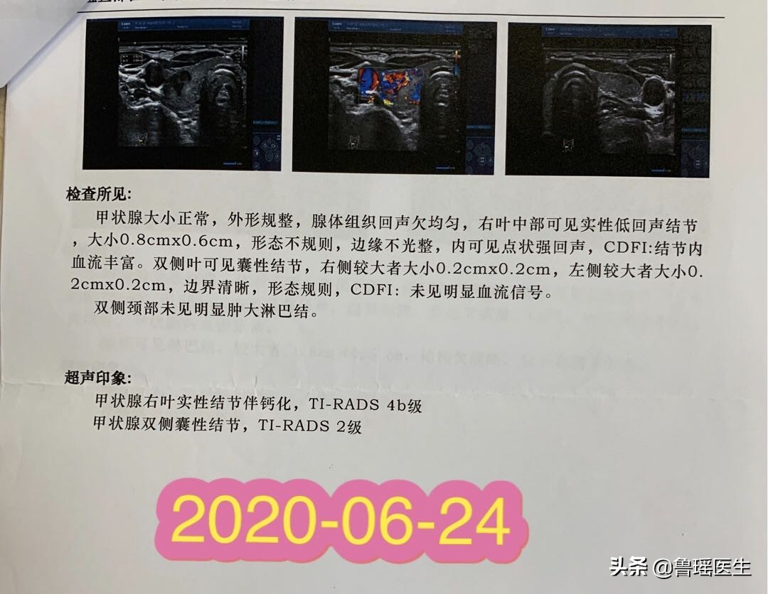 做b超一定能发现甲状腺结节吗,多次b超对结节有刺激吗