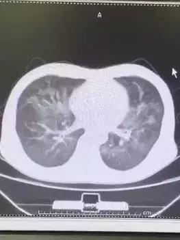 以为是肺炎,竟然得了艾滋病!HIV您真的了解吗?