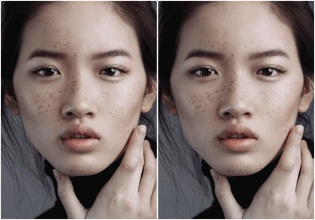 颧骨高太阳穴凹陷怎么改善脸型,颧骨宽大太阳穴凹陷快速改善