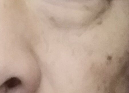 脸上被太阳晒的黑斑怎么去除,脸上长黑斑怎么去除最快方法