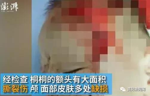 男子被一条狗疯咬,男子被狗追咬全身缝300多针