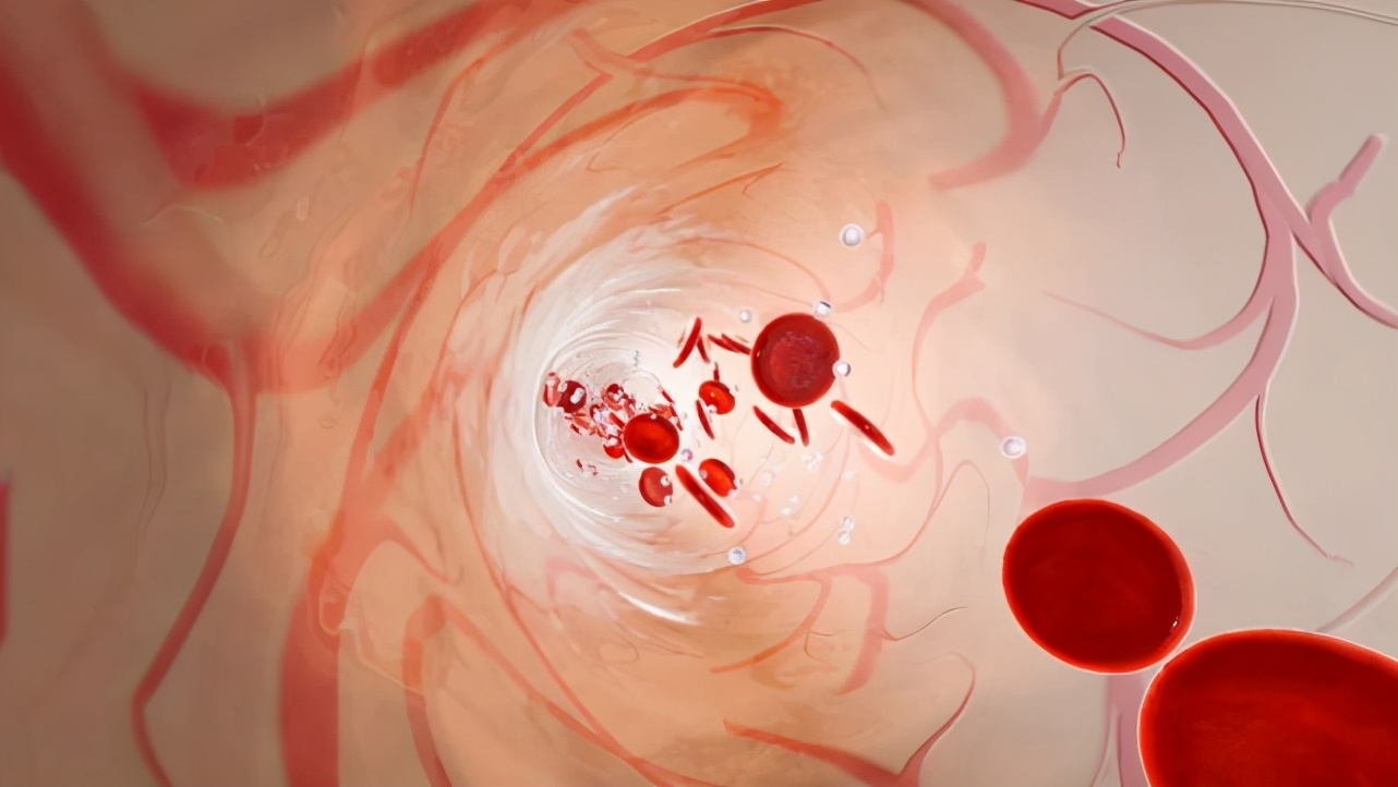 胡大一冠状动脉严重狭窄不做支架,ct显示冠状动脉钙化要紧吗