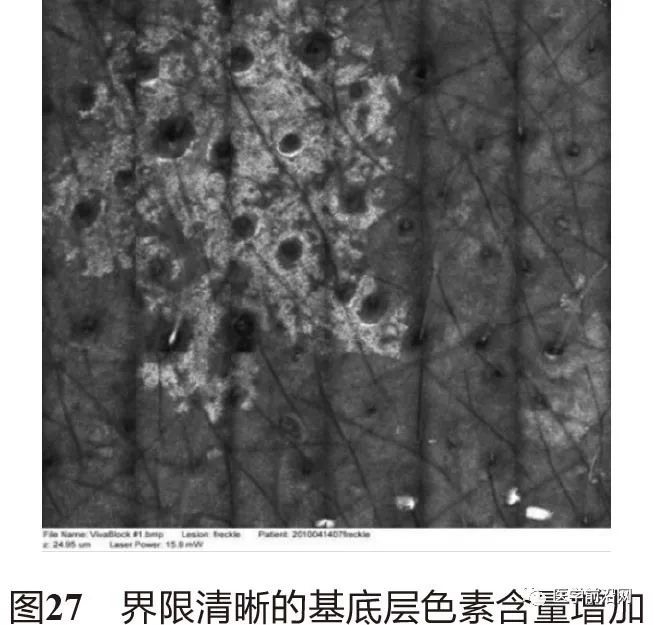 皮肤共聚焦显微镜能查什么,皮肤镜和共聚焦显微镜