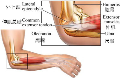 网球肘是否常见肘前外侧痛,网球肘能引肘关节和肩关节疼痛吗
