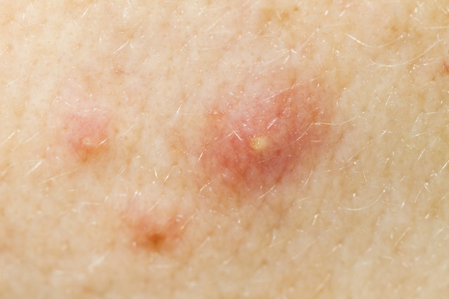 脓包有白色脓点能挤吗,痘痘挤出来的白色乳浆要挤吗