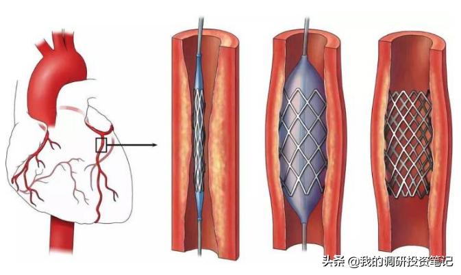 上市公司游记系列：欲往高处走的蓝帆医疗