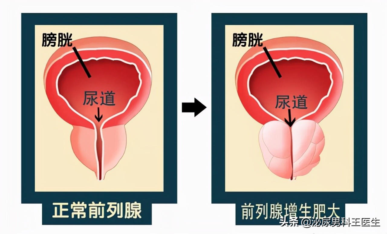 25岁前列腺增生是什么原因引起的,前列腺增生多久做一次psa检查好
