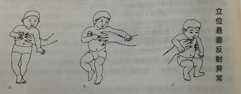 脑瘫儿童的七种异常姿势,判断宝宝脑瘫最简单的方法
