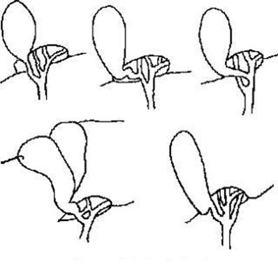 微创胆囊切除后伤口多久彻底愈合,胆囊切除是小手术吗