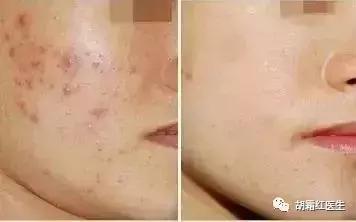 果酸换肤效果如何,果酸换肤的原理