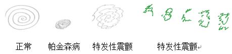 帕金森病不仅仅是手抖这么简单,帕金森病并非手抖那么简单