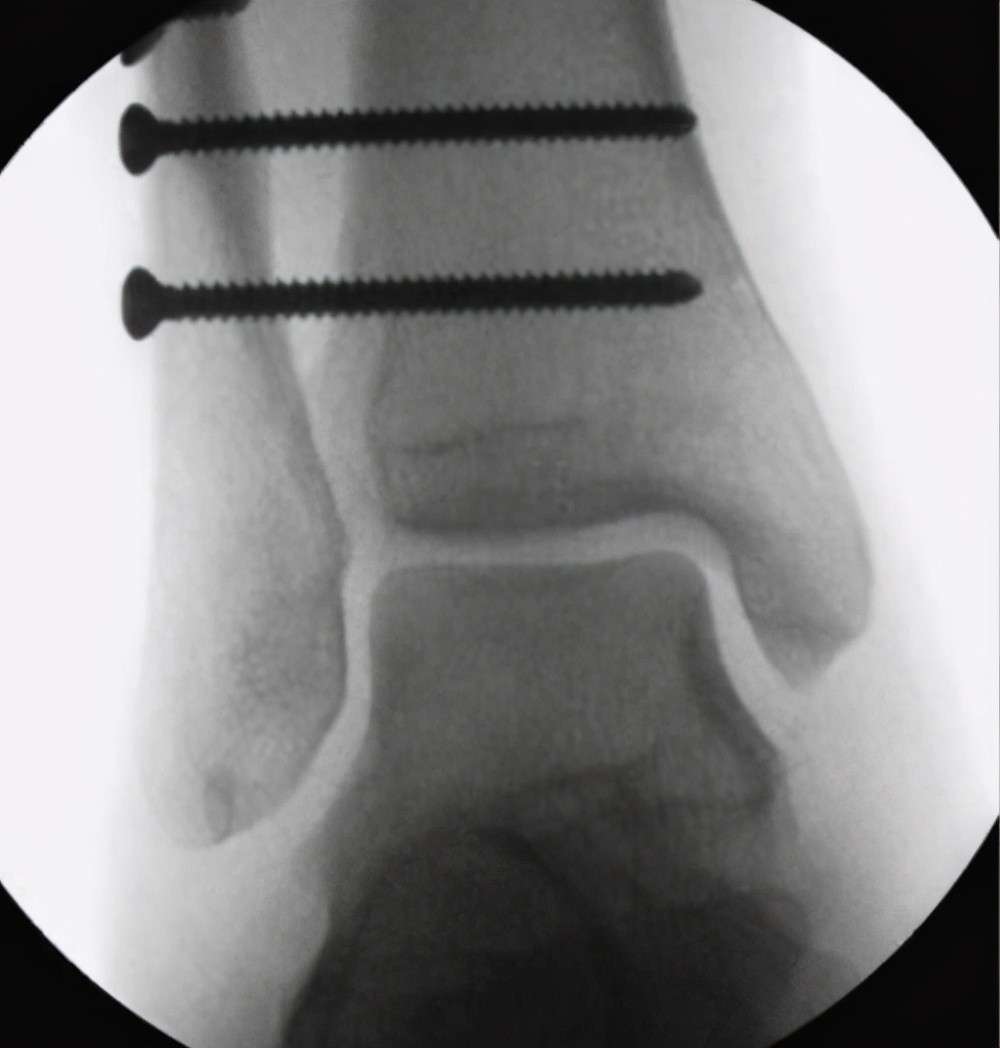 骨折上的钉还用取出来吗,骨折放的钢板是铁的吗