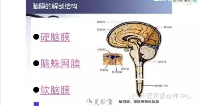 一文读懂颅内胆脂瘤,一文看懂背后的真相