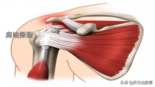 肩周炎:身“肩”重担,怎么治疗才能不带“炎”?