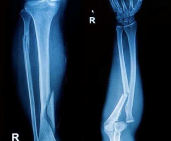 骨髓炎为什么越来越难治疗,如何才算治好慢性骨髓炎