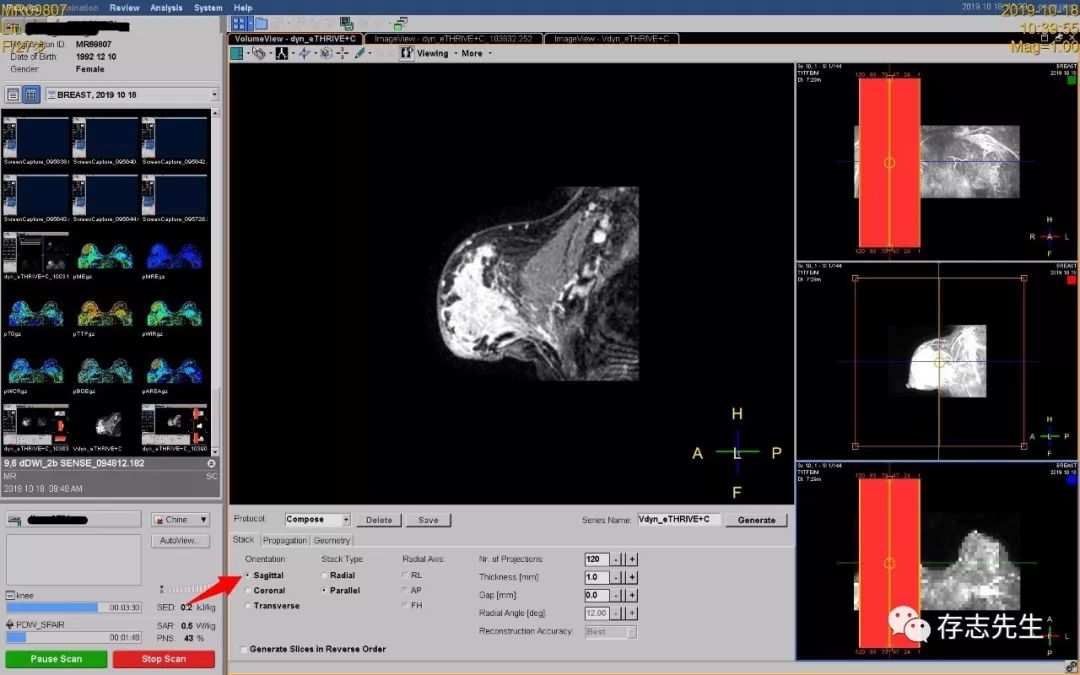 乳腺磁共振亲身经历,磁共振乳腺动态增强扫描全过程