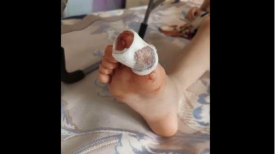 脚大拇指肌腱断裂赔偿价格表,脚大拇指骨头碎该赔多少钱