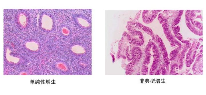 子宫内膜增厚20厘米能怀孕吗,子宫内膜增厚14mm可以怀孕吗
