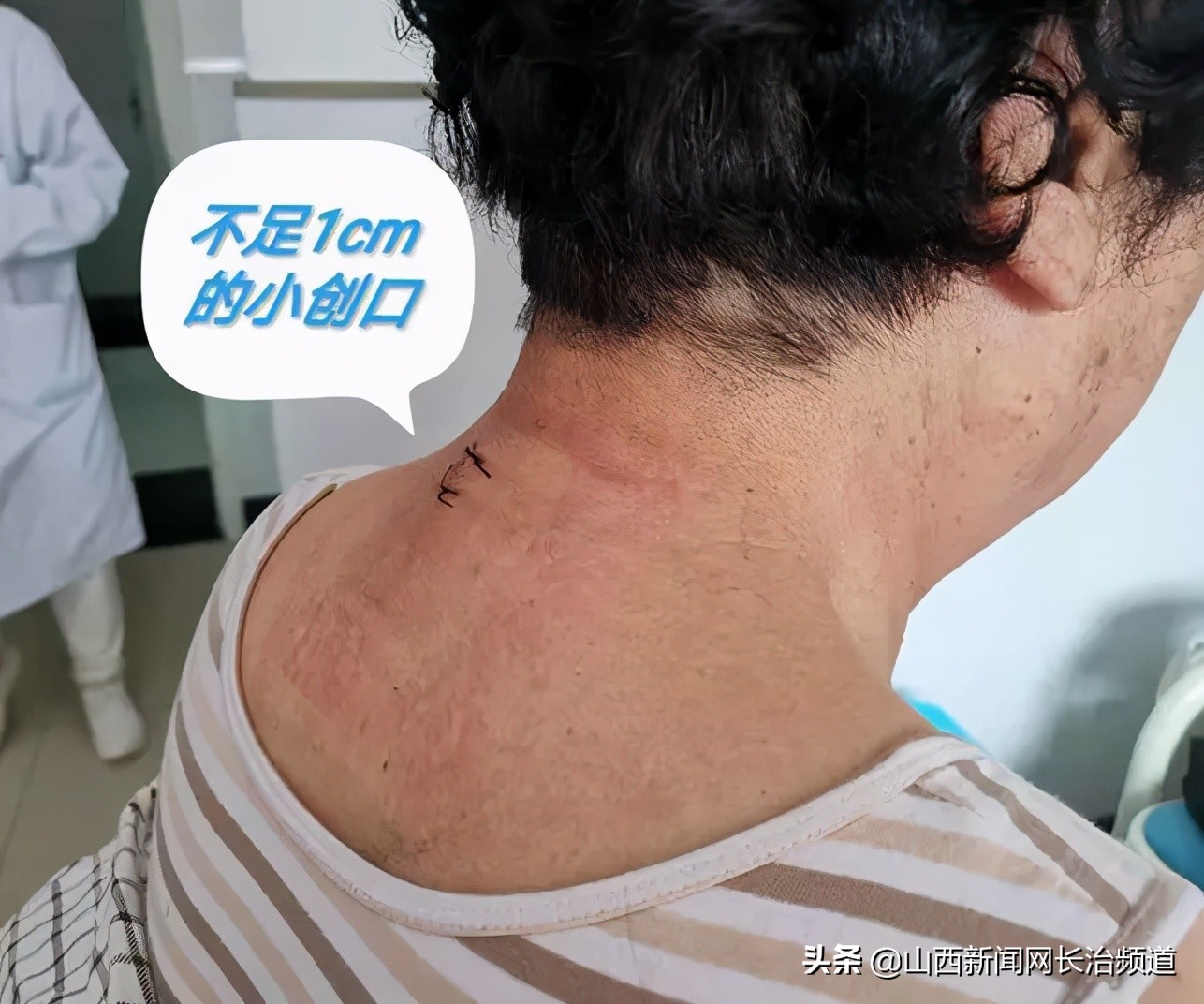 和平技术|疼起来要命的颈椎,一个“钥匙孔”搞定