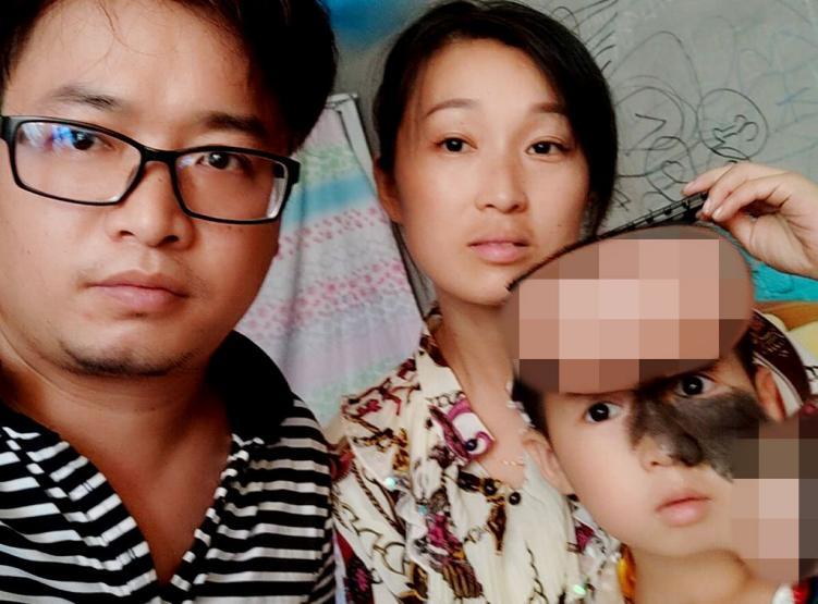 5岁男孩头上长500克重“气球”，历尽5年艰辛只为早日换脸