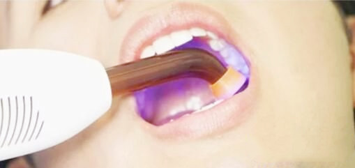 冷光牙齿美白的方法有哪些,viva冷光和皓齿冷光美白的区别