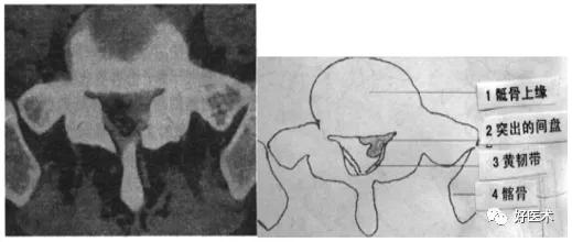 腰部ct需要注意事项,做腰部ct需要注意的事项
