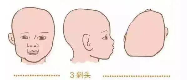 一岁宝宝睡偏头戴婴儿矫正头盔,七个月宝宝戴头盔多久能纠正头型