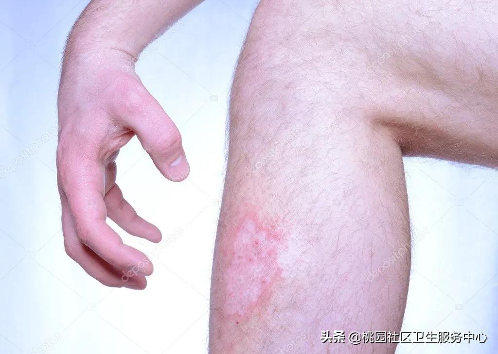 寒冬季节，糖尿病患者出现皮肤瘙痒该怎么处理？