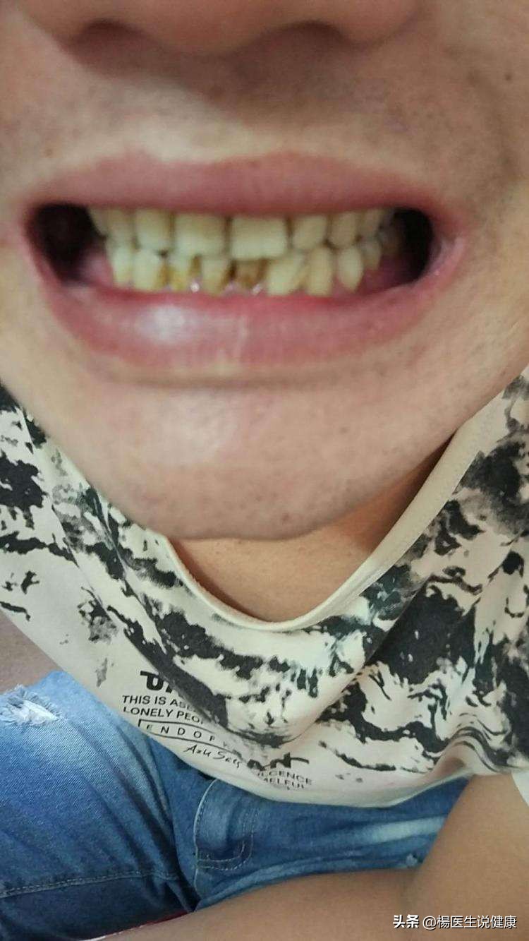 牙齿上的黄泥是什么,牙齿抠出来的东西为什么那么臭