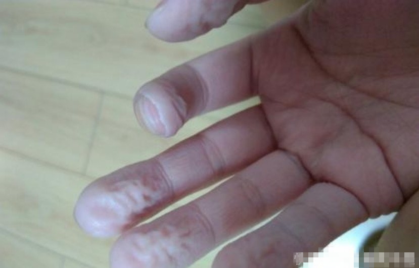 一只手容易泡皱什么原因,手掌像水泡起皱发白是什么原因