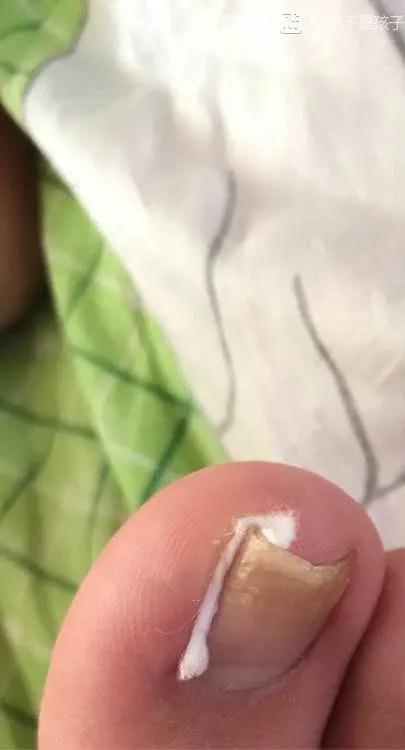 儿童怎么预防甲沟炎,美甲能预防甲沟炎吗