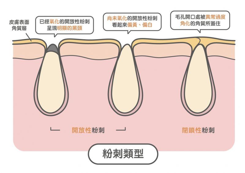 控油清洁毛孔,清洁控油收缩毛孔步骤