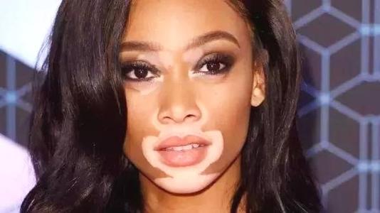 白癜风最严重的六大原因,以为自己得了白癜风