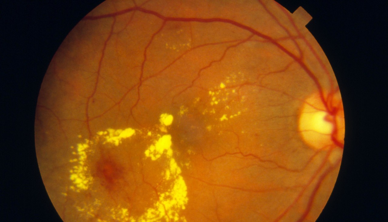 甲状腺相关性眼病临床上有家族聚集性的特征，是一类多基因遗传病