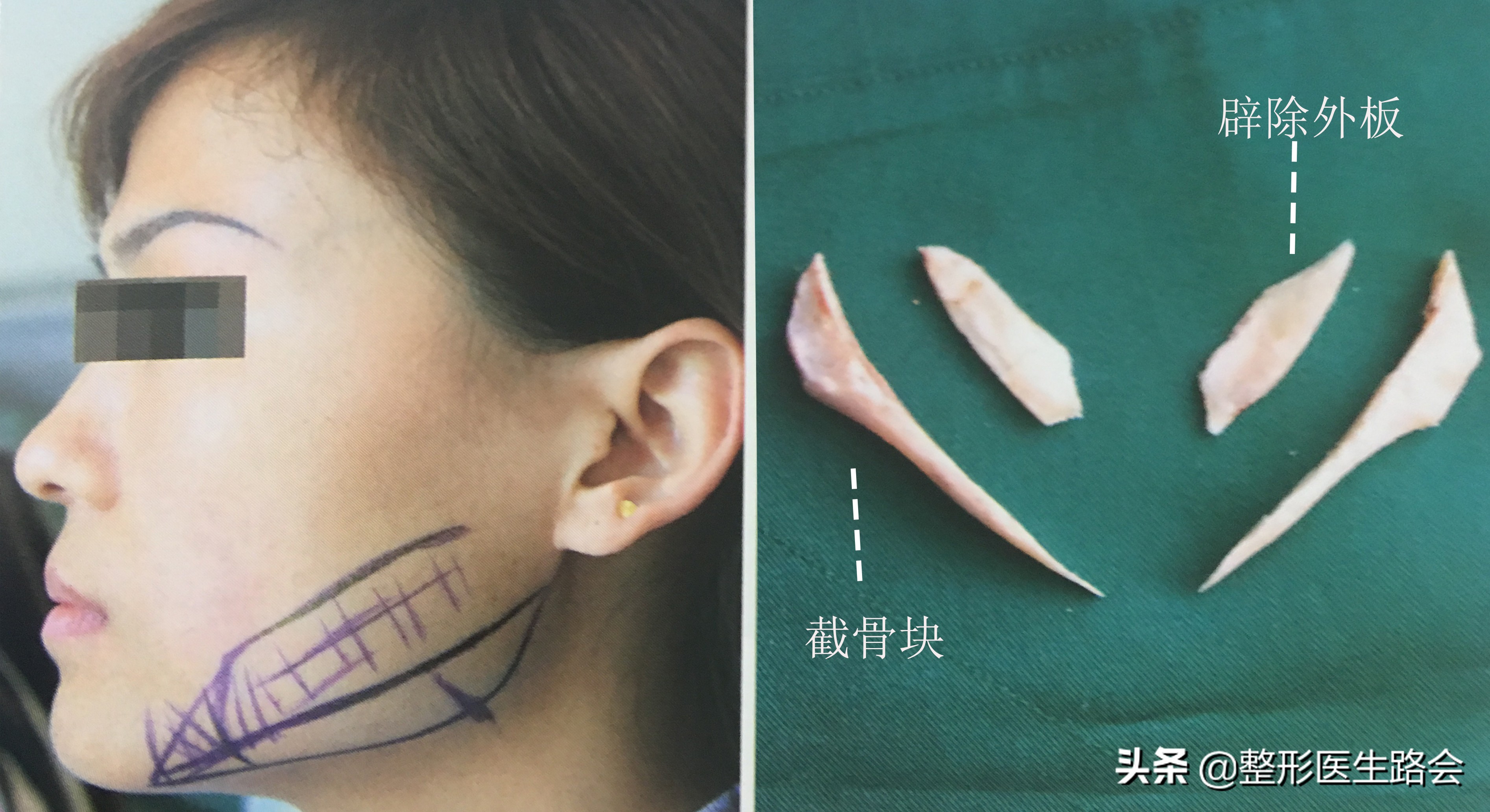 脸又大又宽怎么办,脸短窄怎么治疗