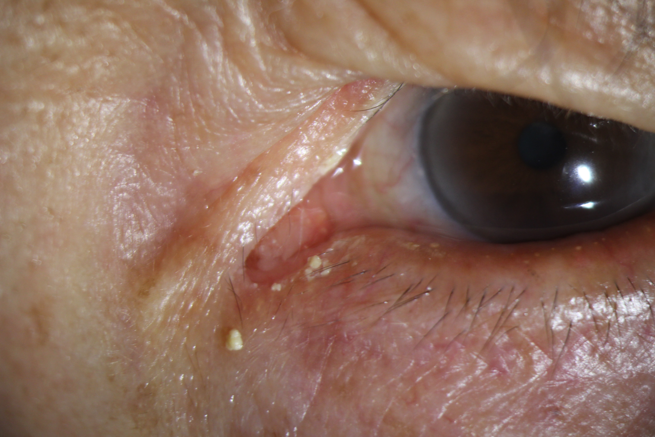 眼角碰肿了总是流眼泪怎么办,眼睛流眼泪眼角有脓