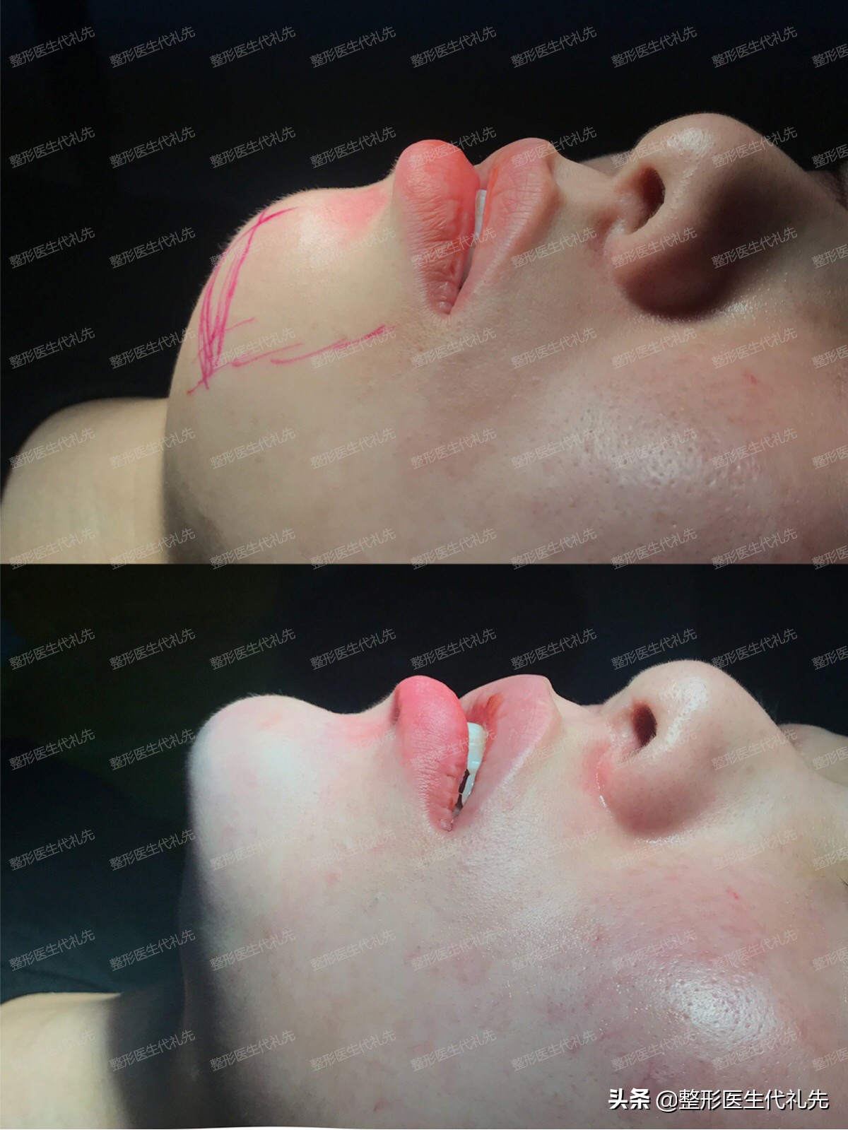 你真的适合隆鼻吗,短下巴适合填充下巴吗