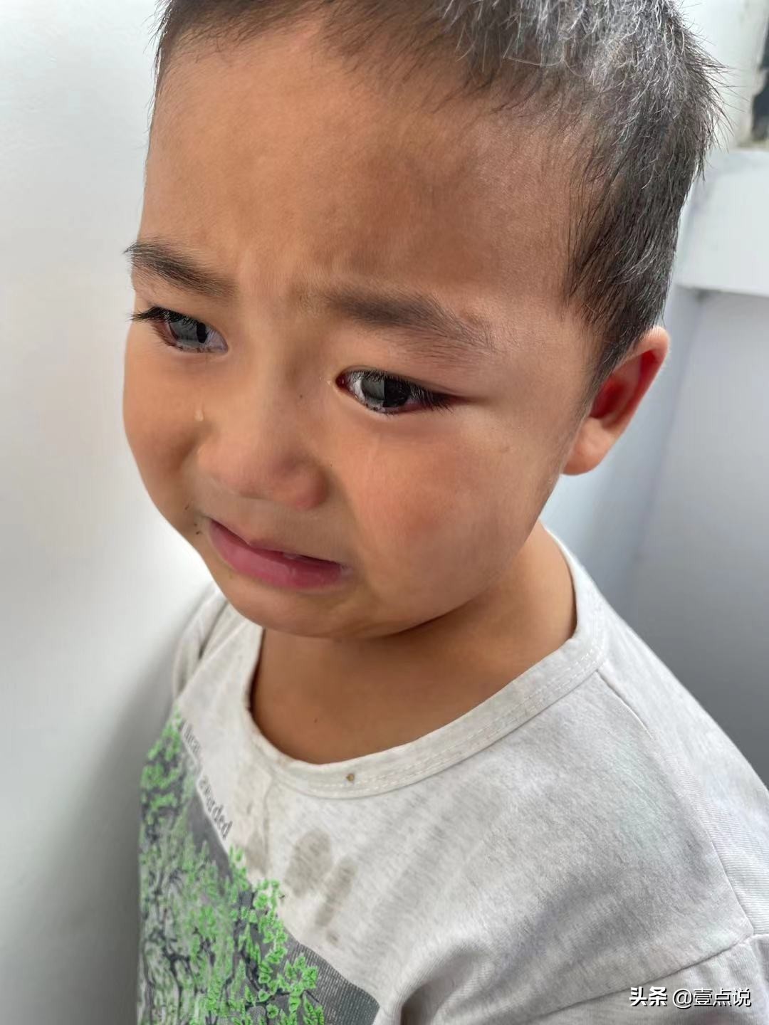 意外毁容真实案例,因为一次意外毁了女孩的一生